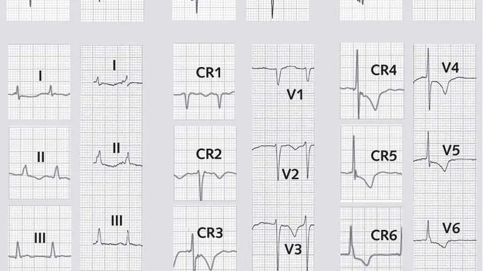 La realización de un electrocardiograma completo con un smartwatch, que tiene un índice de fiabilidad equiparable a los electros que se realizan en los centros sanitarios