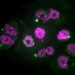 Ejemplo de células tumorales de adenocarcinoma de páncreas