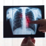 Las autoridades sanitarias chinas aprueban lurbinectedina para el uso compasivo frente al cáncer de pulmón
