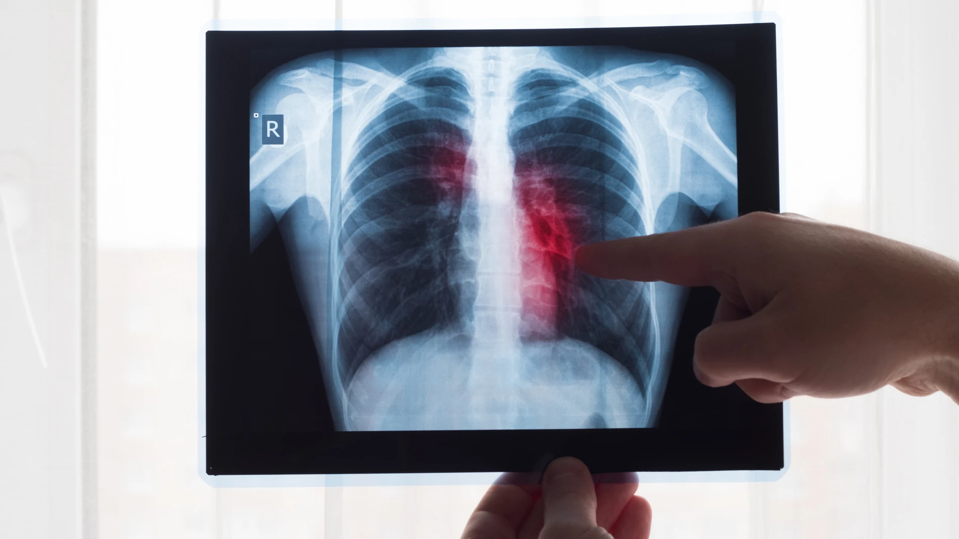 Las autoridades sanitarias chinas aprueban lurbinectedina para el uso compasivo frente al cáncer de pulmón
