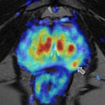 Detalle de un tumor de pr&oacute;stata