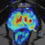 Detalle de un tumor de próstata