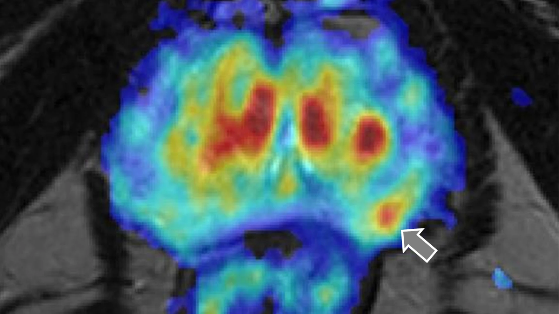Detalle de un tumor de próstata