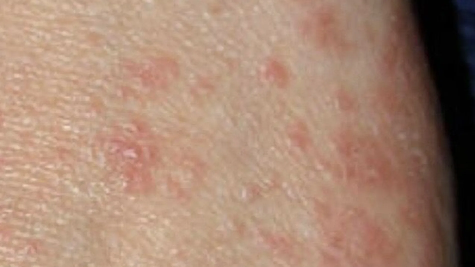 La sarna es una enfermedad contagiosa de la piel causada por un ácaro