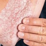 Psoriasis en brazoAEDV