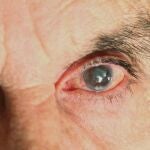 Aprueban en EE UU faricimab (Roche), que trata dos de las principales causas de pérdida de visión