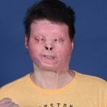 Antes y después del trasplante de cara y de las dos manos a Joe DiMeo