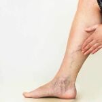Varices