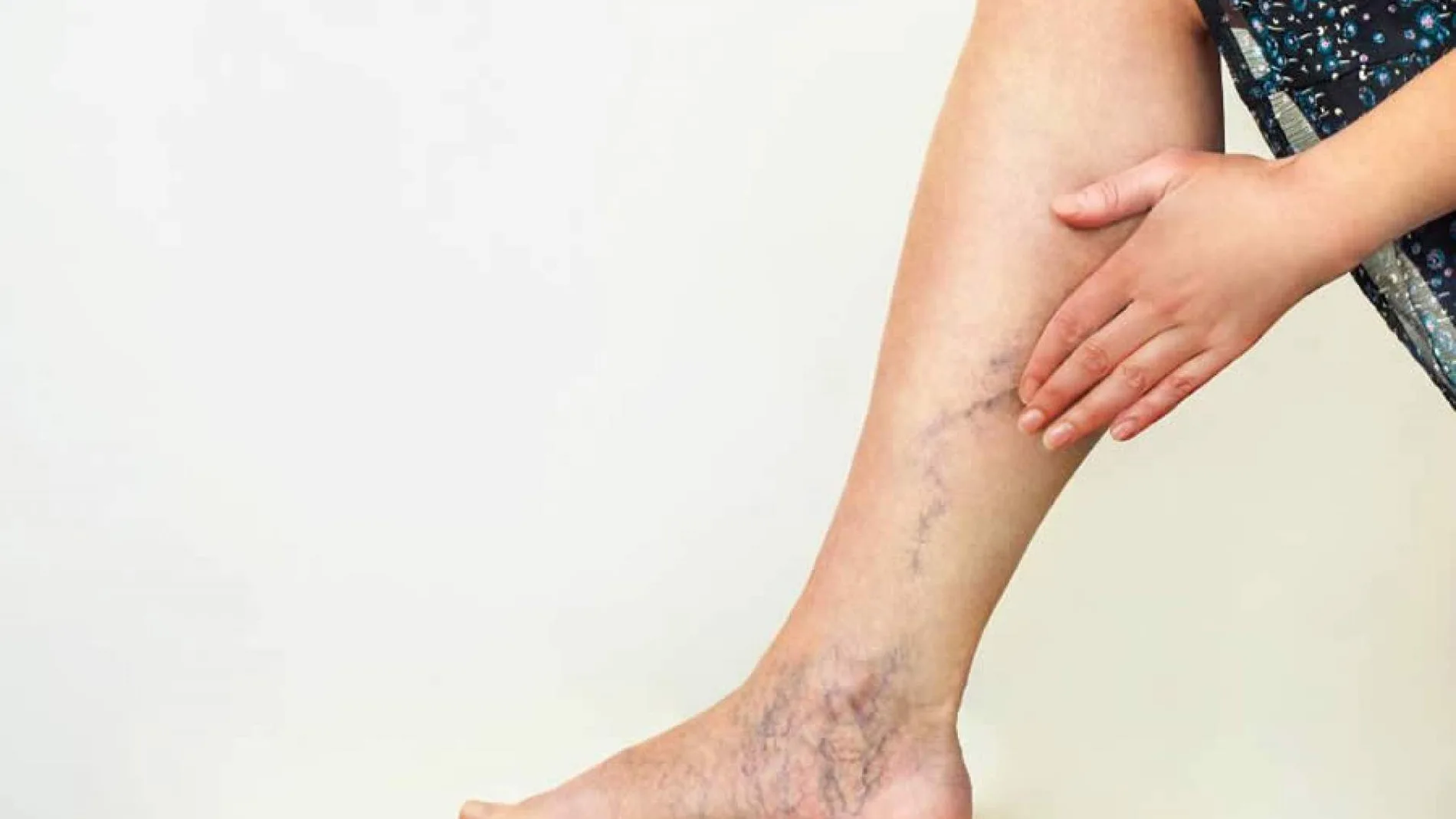 Varices