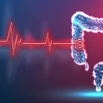 Cáncer de colon
