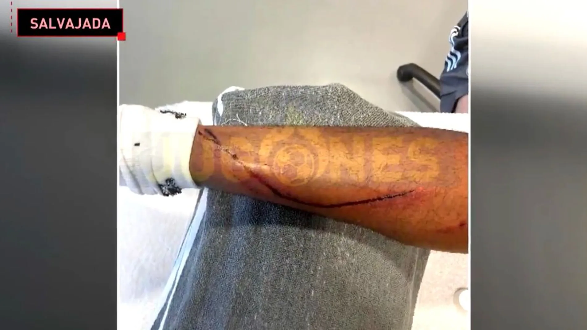 La pierna de Marvin, tras la patada en el Granada-Real Madrid