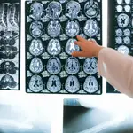 El ictus, primera causa de daño cerebral adquirido que afecta a población cada vez más joven
