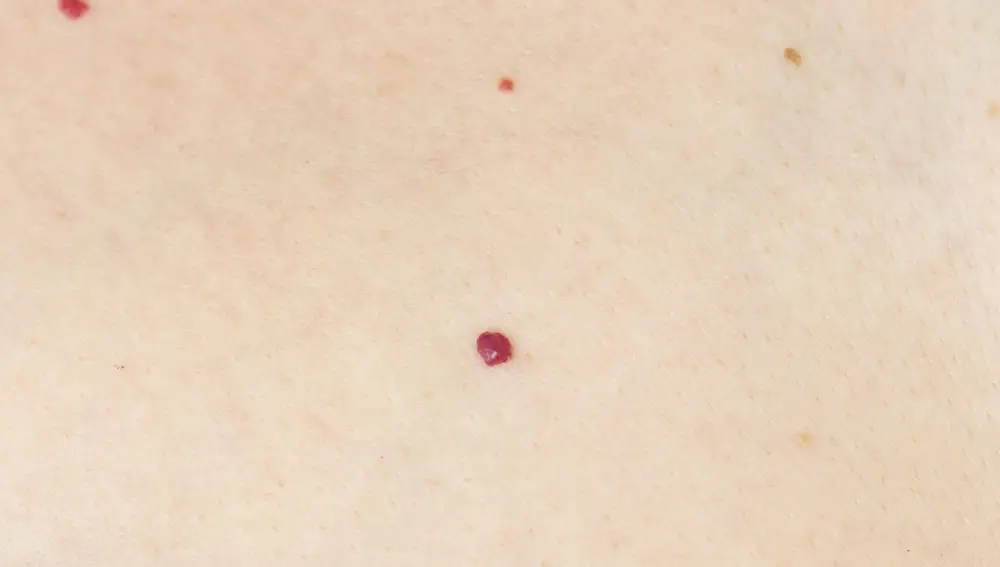 Angioma capilar adquirido