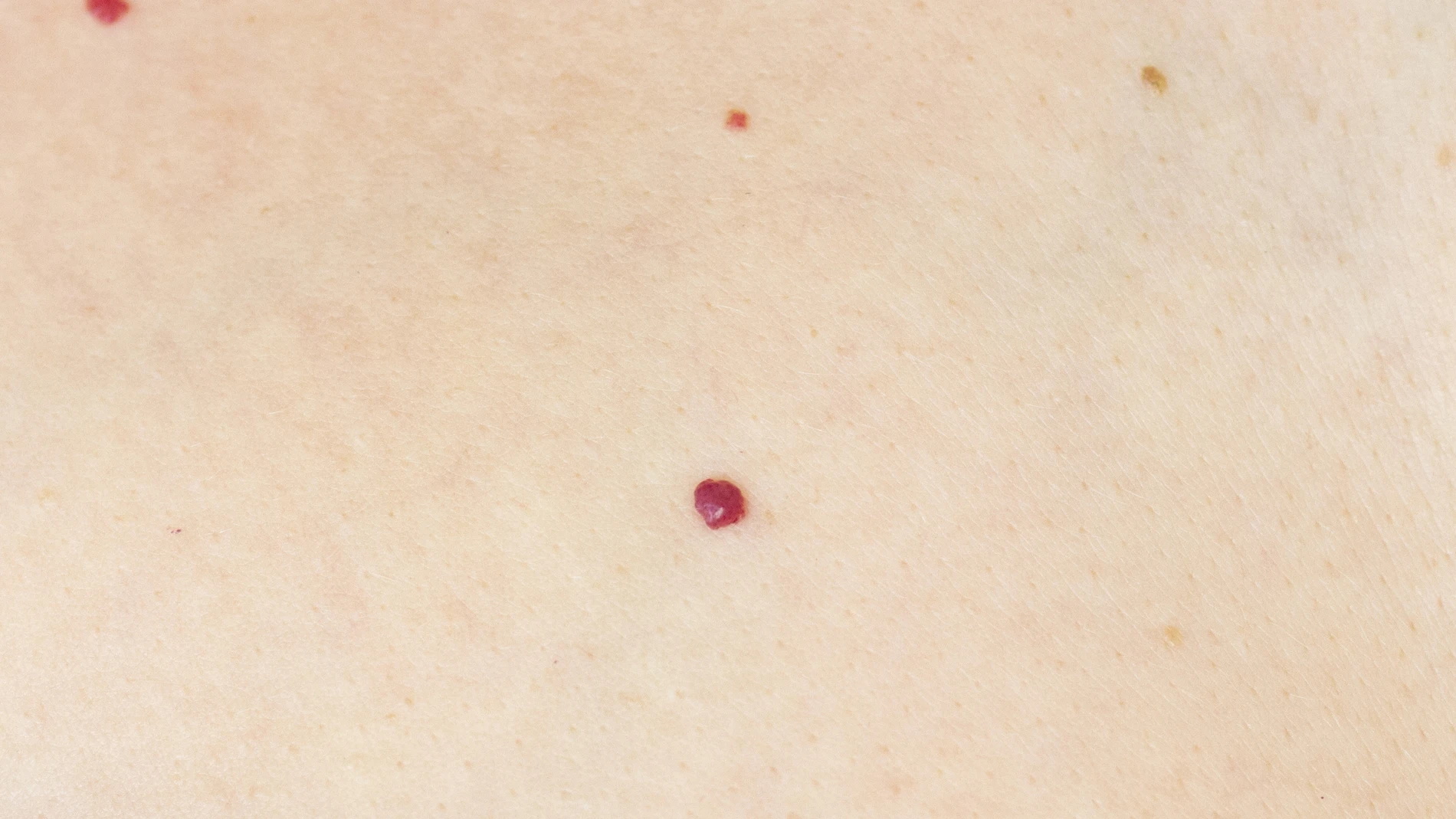 Angioma capilar adquirido