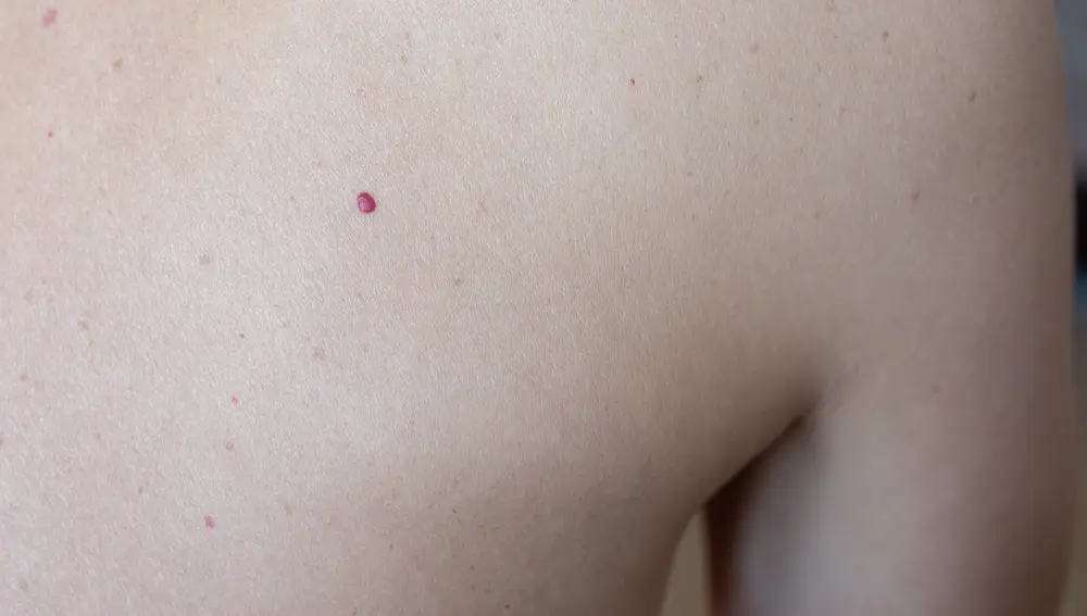 Angioma capilar adquirido