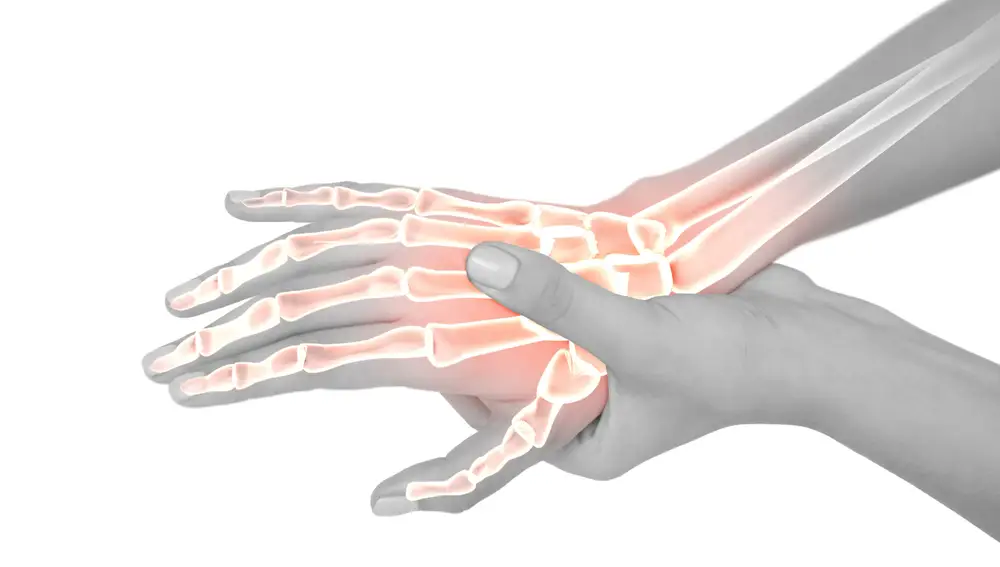 La artritis es una enfermedad inflamatoria autoinmune que produce dolor articular