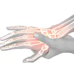 La artritis es una enfermedad inflamatoria autoinmune que produce dolor articular