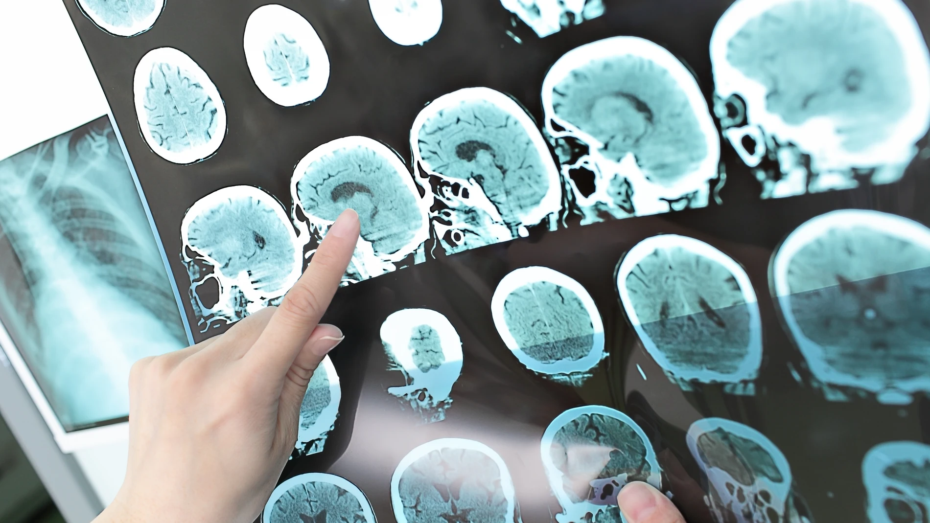 Escaner cerebro. esclerosis múltiple