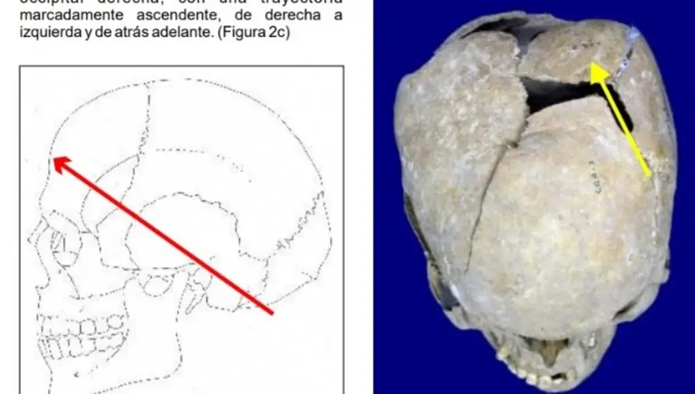 Todas las lesiones traumáticas se localizan a nivel craneal, como refleja el estudio sobre la fosa