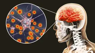La meningitis es una enfermedad infecciosa, contagiosa que afecta a personas de todas las edades La meningitis es una enfermedad infecciosa, contagiosa que afecta a personas de todas las edades