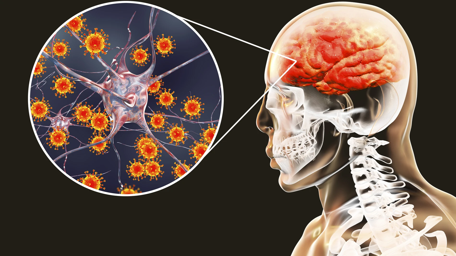La meningitis es una enfermedad infecciosa, contagiosa que afecta a personas de todas las edades