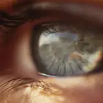 El glaucoma es la segunda causa de ceguera en el mundo.