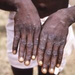 Imagen de 1997 proporcionada por los Centros para el Control y la Prevención de Enfermedades (CDC) durante una investigación sobre un brote de viruela del simio, que tuvo lugar en la República Democrática del Congo (RDC)