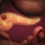 El cáncer de páncreas es uno de los que presenta peores tasas de superviviencia