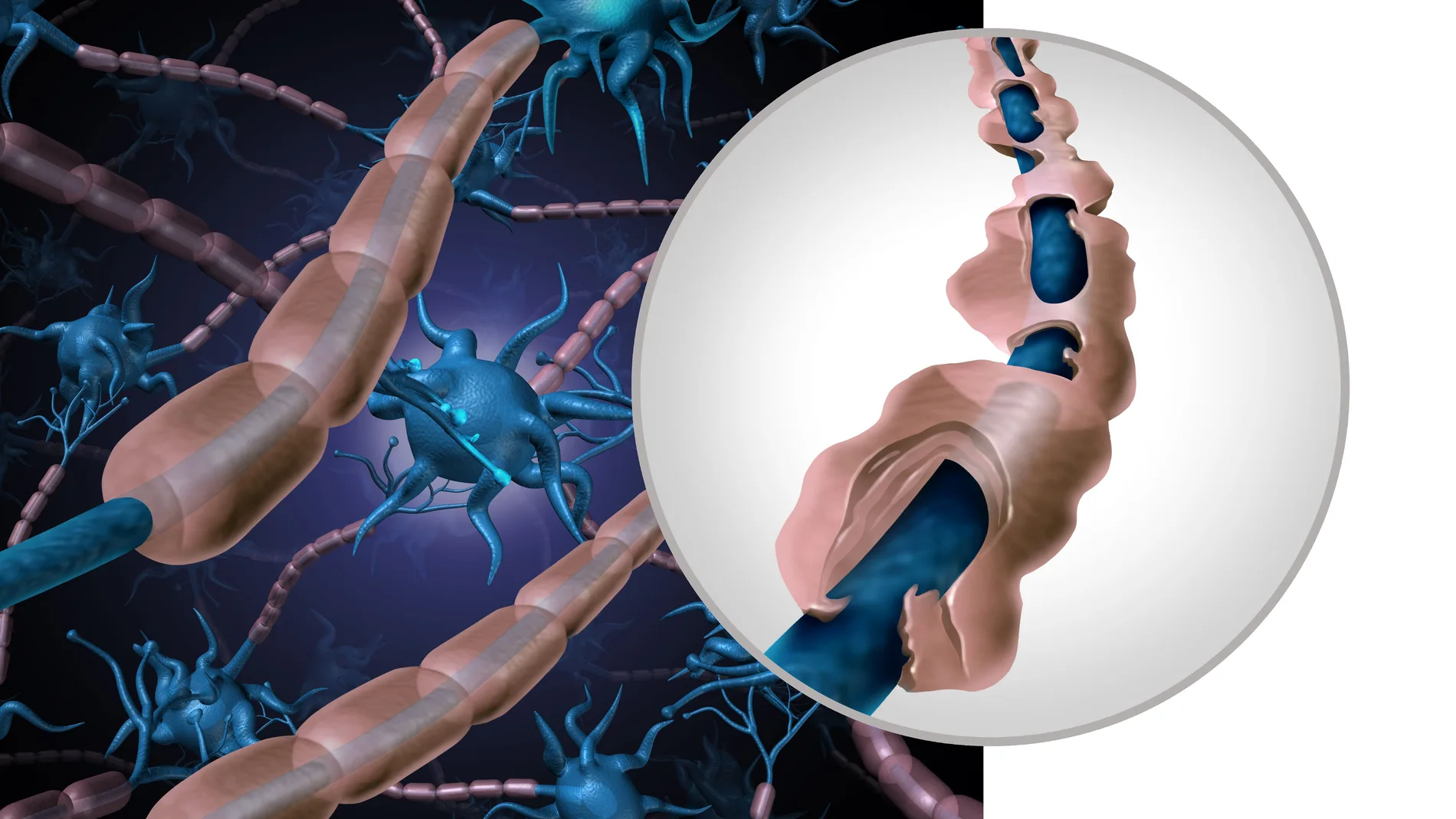 Un fármaco oral que retrasa la evolución de la esclerosis múltiple, las recaídas y la fatiga