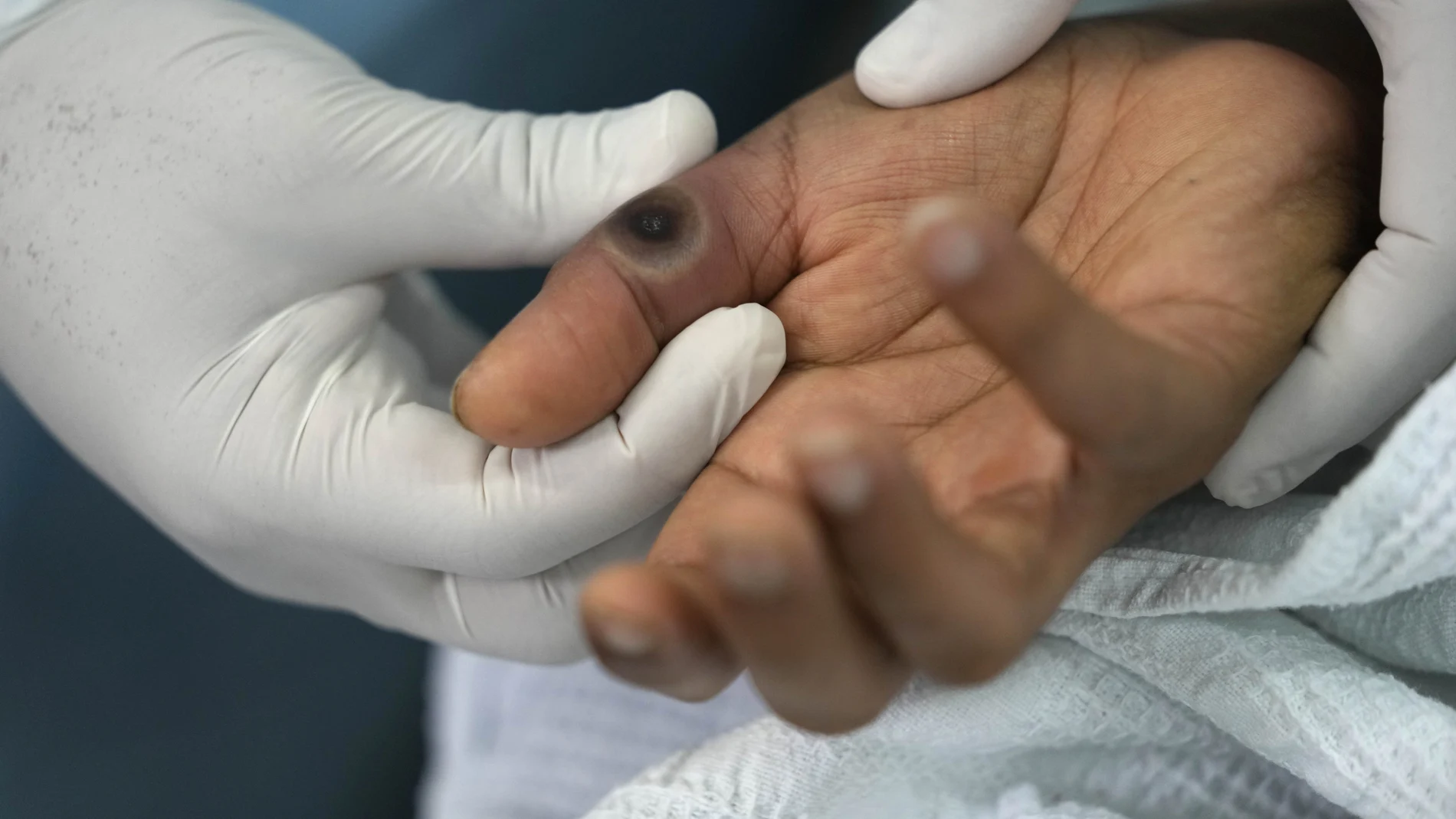 Un médico muestra las lesiones de un paciente causadas por la viruela del mono