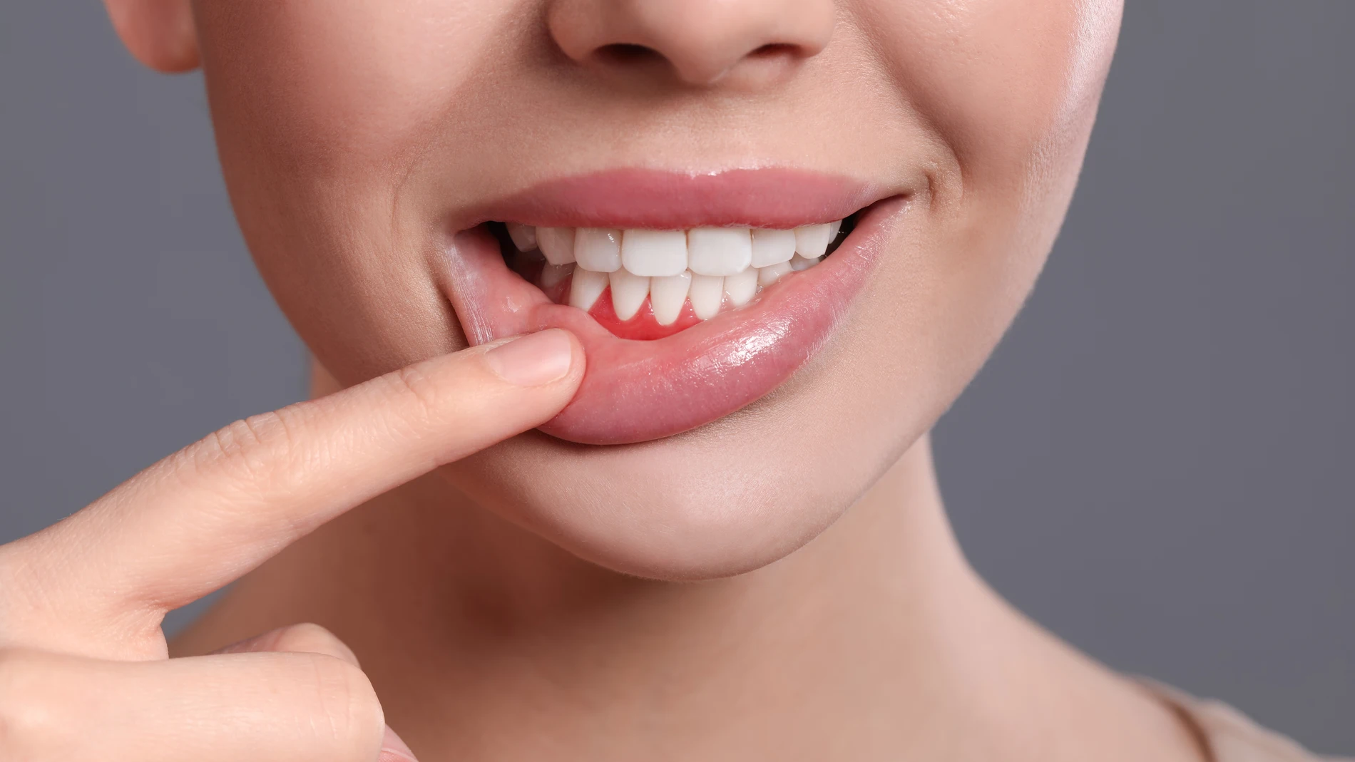La periodontitis, también llamada enfermedad de las encías, es una grave infección que daña el tejido blando.
