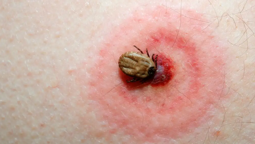 La garrapata que les picó estaba infectada con la bacteria Rickettsia, que les provocó la fiebre de las Montañas Rocosas