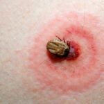 La garrapata que les picó estaba infectada con la bacteria Rickettsia, que les provocó la fiebre de las Montañas Rocosas