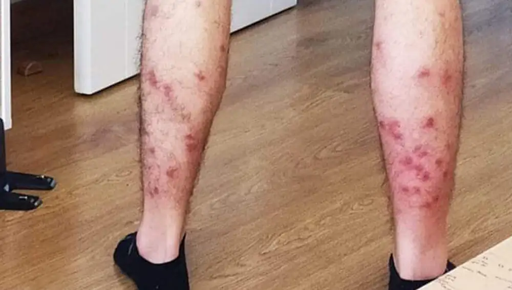 Efectos de la mordedura de la mosca negra