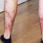 Efectos de la mordedura de la mosca negra 