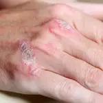 Artristis psoriásica