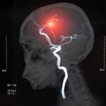 Ictus. HOSPITAL LA LUZ
