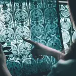 Según nuevos hallazgos haber padecido Covid-19 aumenta el riesgo de padecer Alzheimer