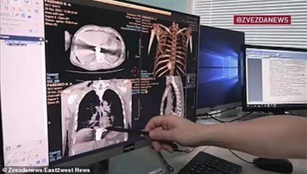 El protyectil estuvo a punto de dañar dos venas lo que le habría provocado una muerte rápida
