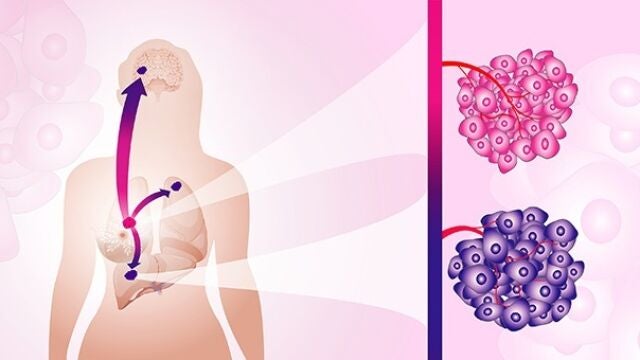 La imagen muestra un tumor primario de cáncer de mama (rosa) y los tumores metastásicos/secundarios (púrpura).