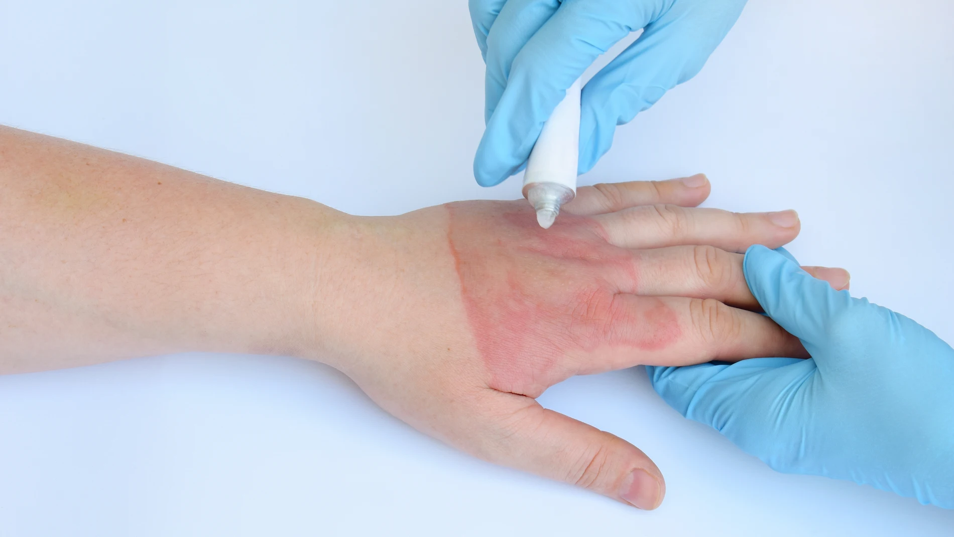 Tratamiento de quemaduras con pomada o crema