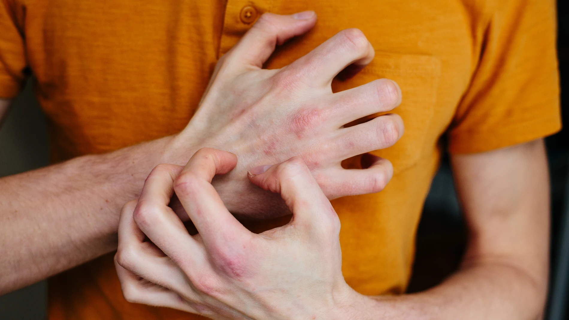 Psicodermatología