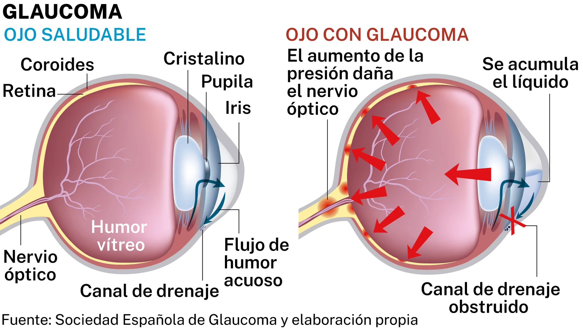 Glaucoma