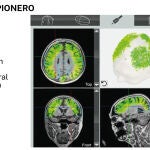 Alzheimer