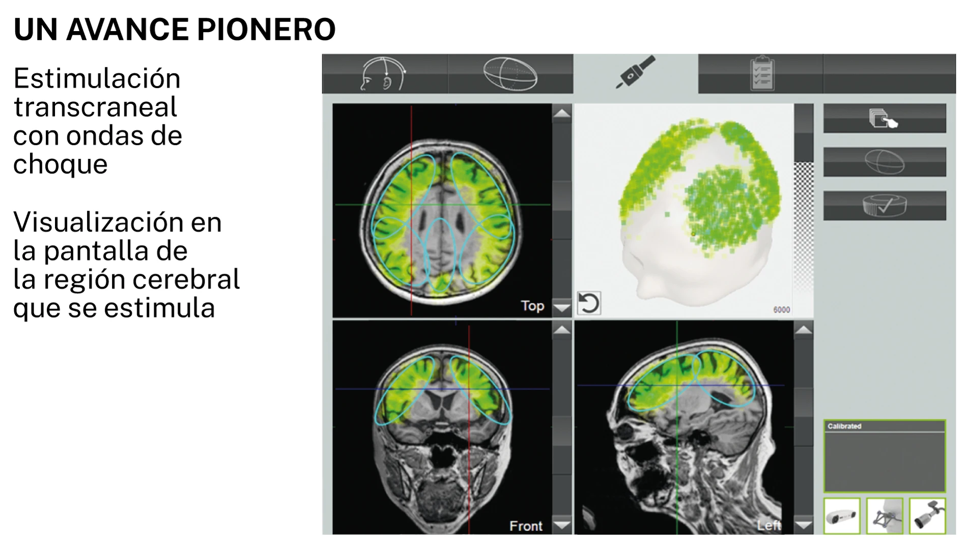 Alzheimer