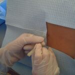 La punción lumbar para extraer y analizar el líquido cefalorraquídeo es, a día de hoy, la técnica para medir los biomarcadores de Alzheimer