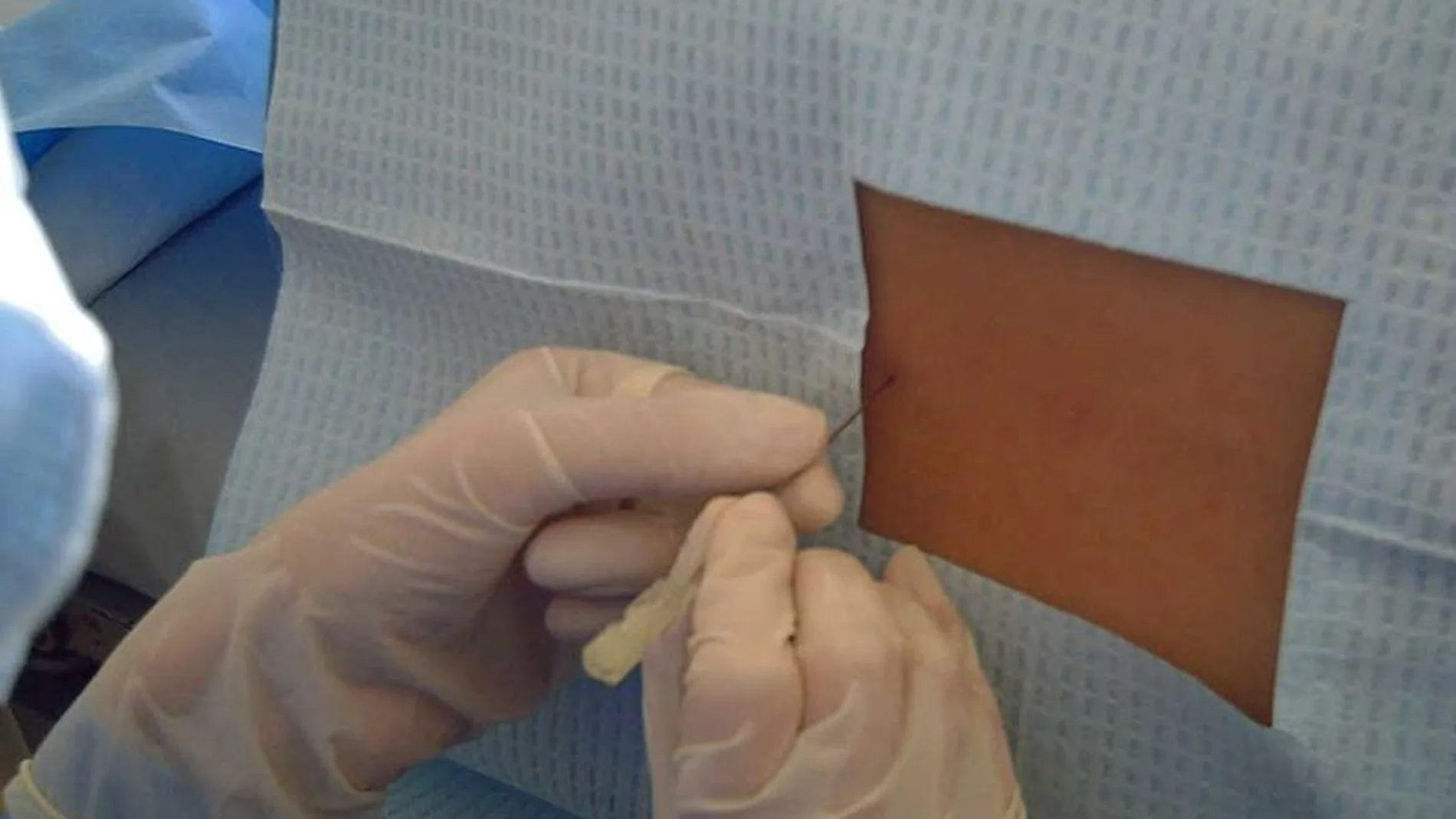 La punción lumbar para extraer y analizar el líquido cefalorraquídeo es, a día de hoy, la técnica para medir los biomarcadores de Alzheimer
