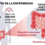 Colitis ulcerosa