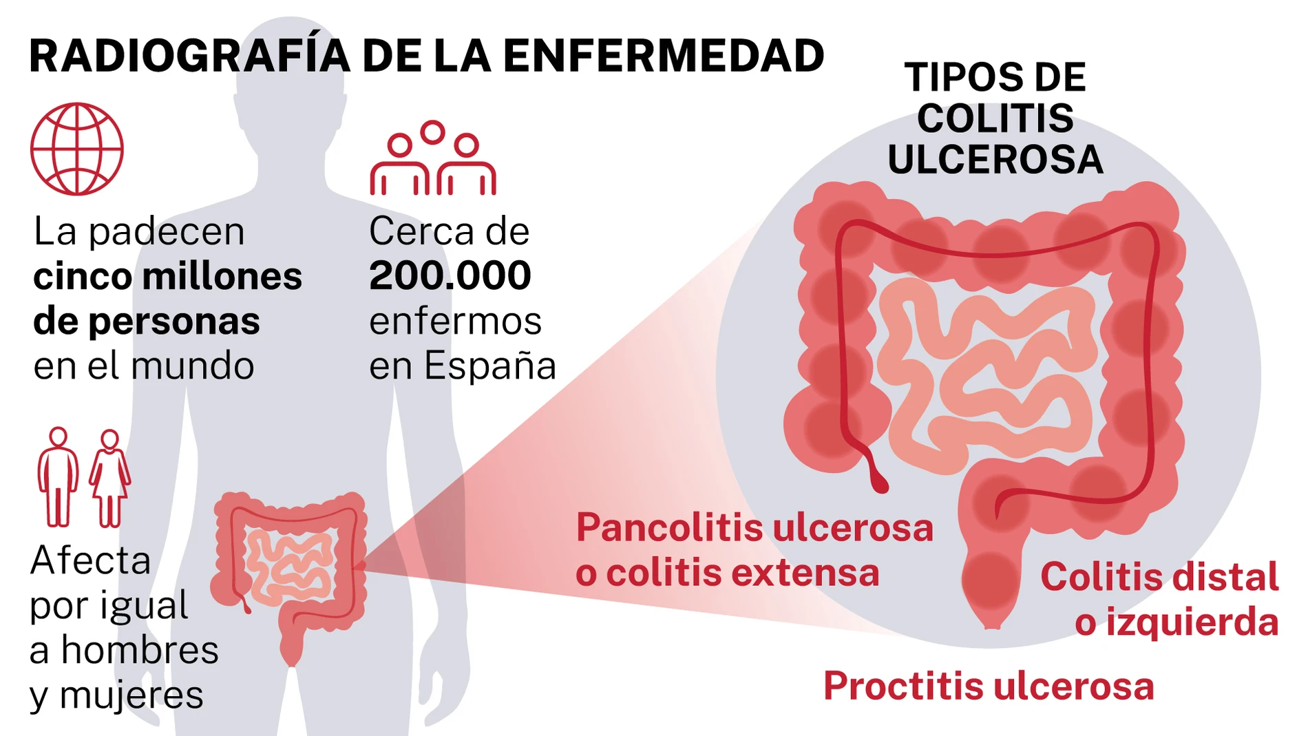Colitis ulcerosa