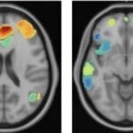A la izquierda cerebro con depresión antes del tratamiento y a la derecha luego de la reversión de las ondas cerebrales